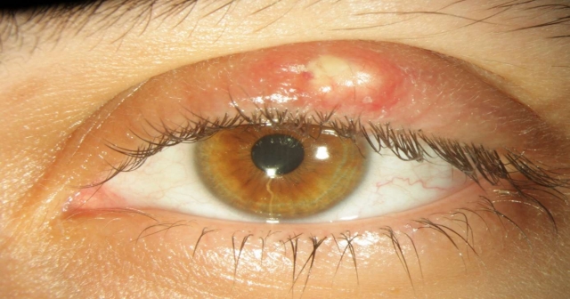 Göz Kapaklarındaki Geçmeyen Yaralara Dikkat, Göz Kanseri Olabilir