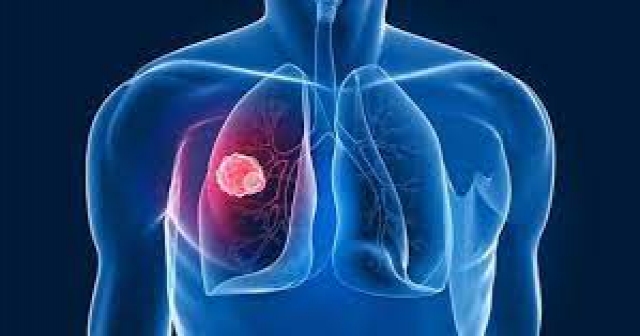 Kadınlarda Akciğer Kanseri Vakalarında Artış