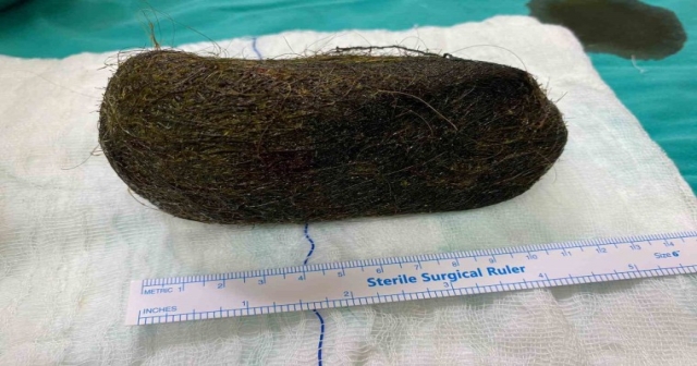 Karın Ağrısıyla Gitti Midesinden 2 Kilo Saç Çıktı