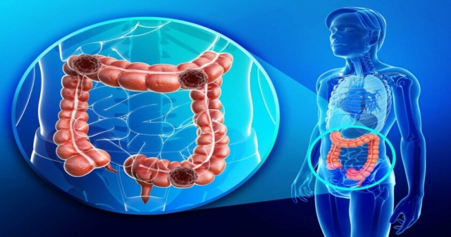 KOLON KANSERİNDE ERKEN TANI VE TEDAVİ HAYAT KURTARIYOR