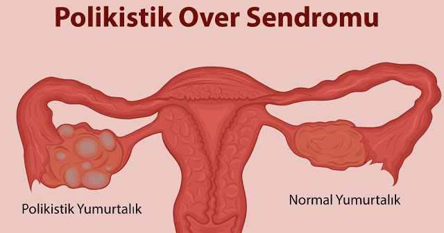 PKOS SENDROMUNUZ VARSA BU 8 BELİRTİYE DİKKAT!