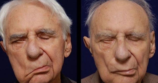 Yüz Felcinde Erken Teşhis Tedavi Şansını Artırıyor